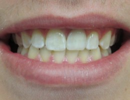 Broken Tooth – AFTER