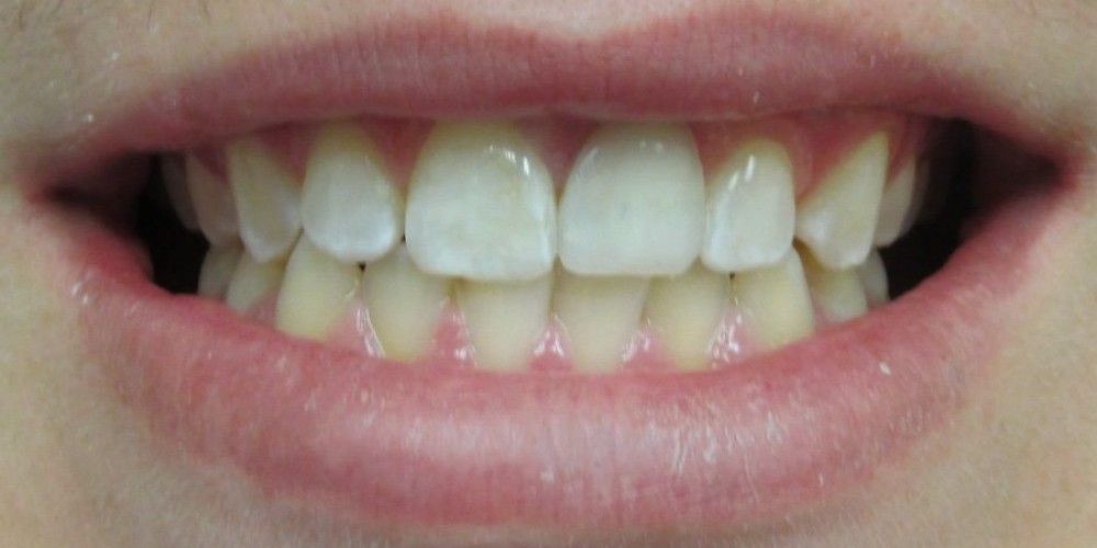 Broken Tooth &#8211; AFTER