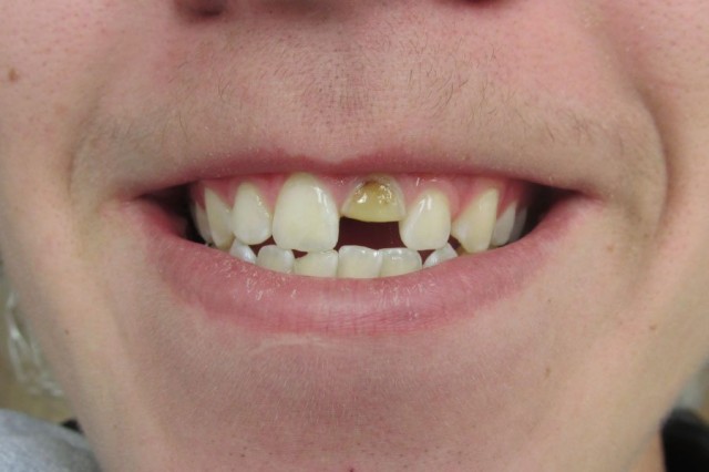 Broken Tooth &#8211; BEFORE