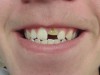 Broken Tooth – BEFORE