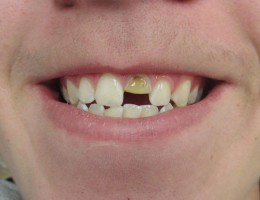 Broken Tooth – BEFORE