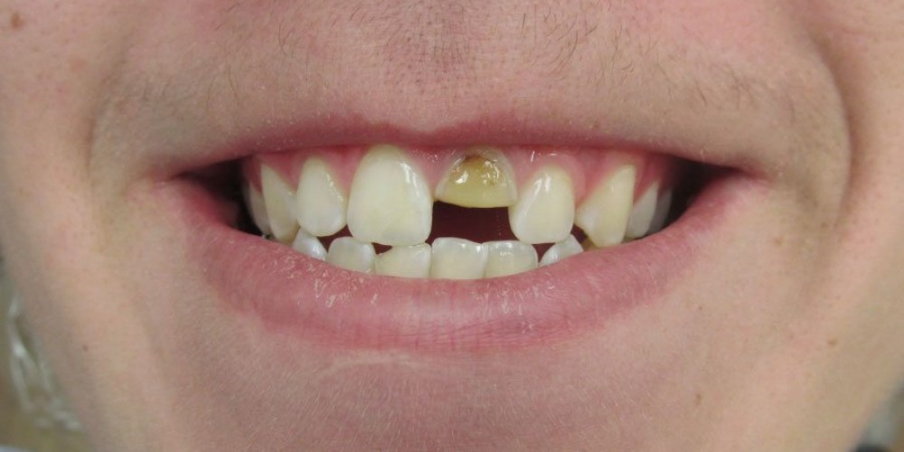 Broken Tooth &#8211; BEFORE