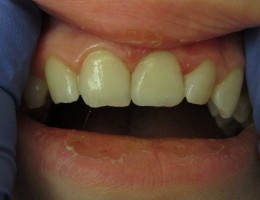 Dental Trauma – AFTER