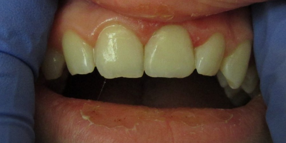 Dental Trauma &#8211; AFTER