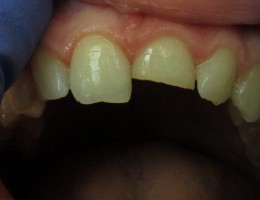Dental Trauma – BEFORE