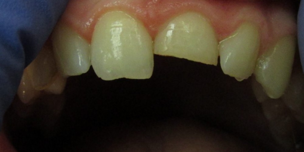 Dental Trauma &#8211; BEFORE