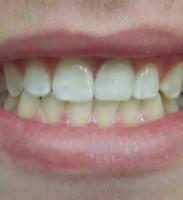 Broken Tooth – AFTER