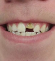 Broken Tooth – BEFORE