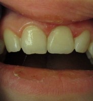 Dental Trauma – AFTER