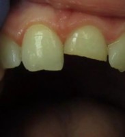 Dental Trauma – BEFORE