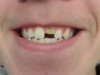 BEFORE Same-day chairside cosmetic bonding