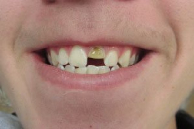 BEFORE Same-day chairside cosmetic bonding